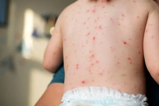 What do you dream about Chickenpox?